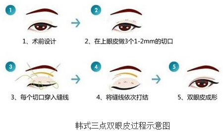 【双眼皮】双眼皮好吗 双眼皮优点