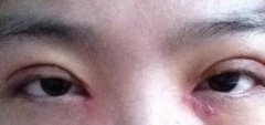 【开眼角疤痕增生】开眼角疤痕增生怎么办 开眼角疤痕增生图片