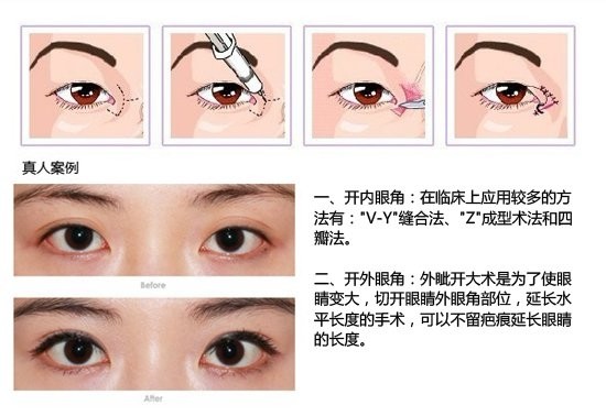 【开眼角疤痕增生】开眼角疤痕增生怎么办 开眼角疤痕增生图片