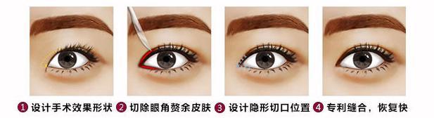 【开眼角疤痕增生】开眼角疤痕增生怎么办 开眼角疤痕增生图片