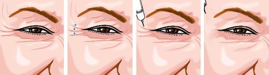 【眼部除皱】眼部除皱的喜欢方式 眼部除皱有哪些方法