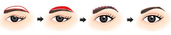 做切眉术降低风险吗 切眉术风险大不大