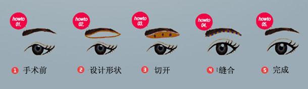 做切眉术降低风险吗 切眉术风险大不大