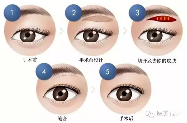 做切眉术降低风险吗 切眉术风险大不大