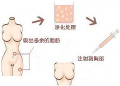 【自体脂肪移植隆胸】自体脂肪移植隆胸手术果怎样 自体脂肪移植隆胸手术能保持多久呢