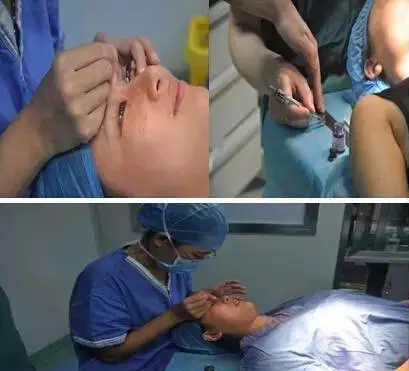 割双眼皮手术后遗症 做双眼皮手术的危害