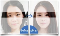双眼皮手术拆线后需要做眼部运动吗