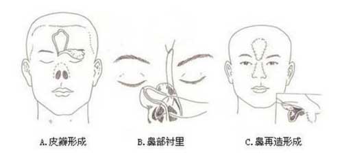 女子惨被丈夫割鼻 鼻部整形术让她不再痛苦