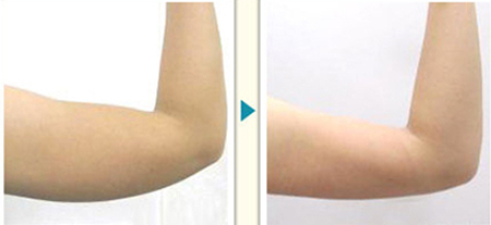手臂吸脂减肥多久可以正常活动 手臂吸脂减肥有什么注意事项