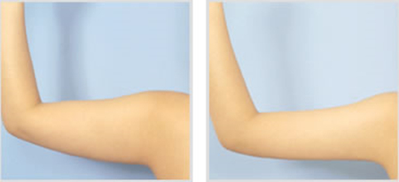 手臂吸脂减肥多久可以正常活动 手臂吸脂减肥有什么注意事项