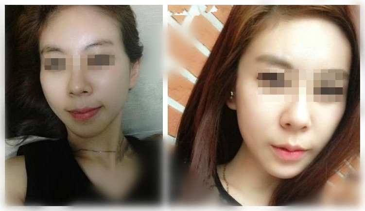 自体脂肪丰太阳穴怎么样 自体脂肪丰太阳穴对身体有害吗