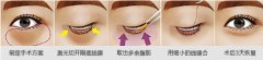 哪种祛眼袋方法果好 去眼袋有的方法 哪种祛眼袋方法果好 去眼袋有的方法