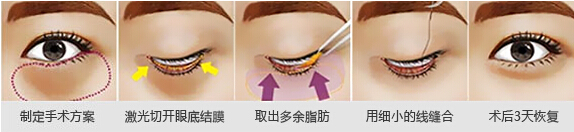 哪种祛眼袋方法果好 去眼袋有的方法