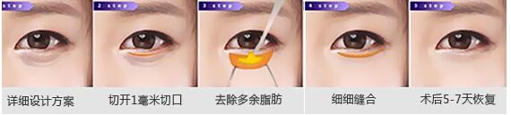 哪种祛眼袋方法果好 去眼袋有的方法