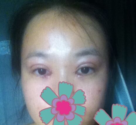 近视眼可以做双眼皮吗 近视眼能割双眼皮吗