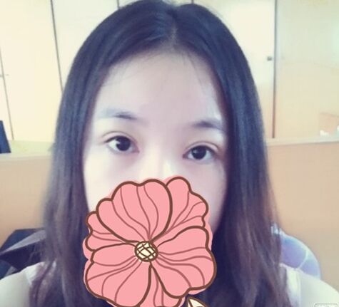 近视眼可以做双眼皮吗 近视眼能割双眼皮吗