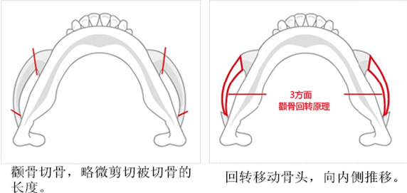 磨颧骨和颧骨内推术有什么区别?哪个创伤小?