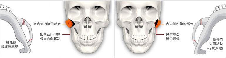 磨颧骨和颧骨内推术有什么区别?哪个创伤小?