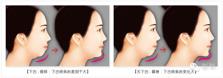 长沙瑞澜整形医院垫下巴整形手术需要多少钱?果到底怎么样?