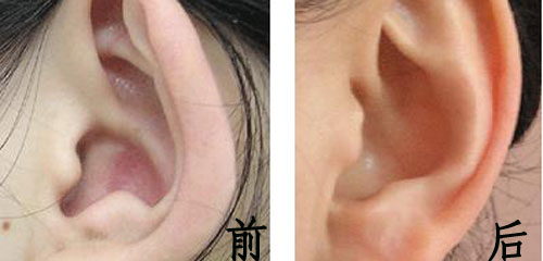 招风耳矫正多少钱 招风耳矫正什么时候喜欢