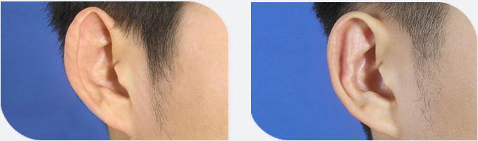 招风耳矫正多少钱 招风耳矫正什么时候喜欢