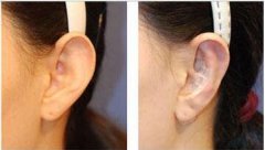 招风耳矫正多少钱 招风耳矫正什么时候喜欢 招风耳矫正多少钱 招风耳矫正什么时候喜欢