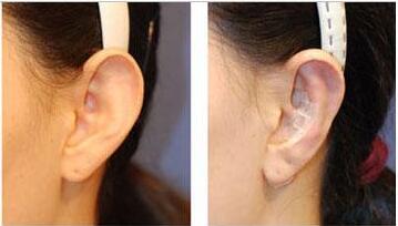 招风耳矫正多少钱 招风耳矫正什么时候喜欢