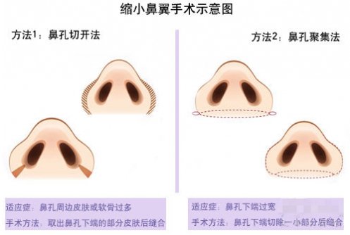 鼻头和鼻翼缩小手术有什么区别？会留疤痕吗？