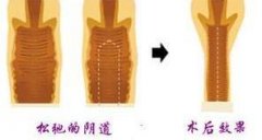 阴道紧缩这个手术惠州哪家医院做的比较好?