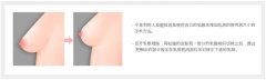 深圳美莱整形做乳房下垂矫正手术需要花多少钱?注意什么?