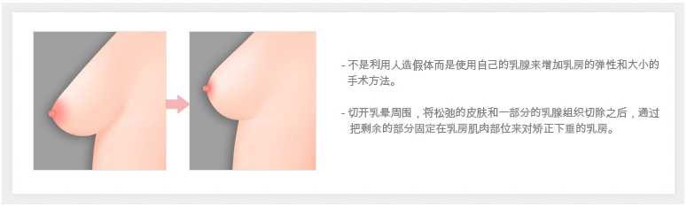 深圳美莱整形做乳房下垂矫正手术需要花多少钱?注意什么?