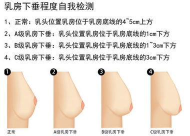 深圳美莱整形做乳房下垂矫正手术需要花多少钱?注意什么?