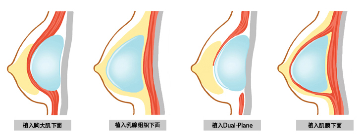 假体隆胸后出现包膜挛缩是怎么回事