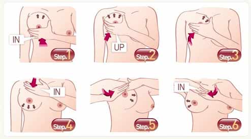 假体隆胸后出现包膜挛缩是怎么回事
