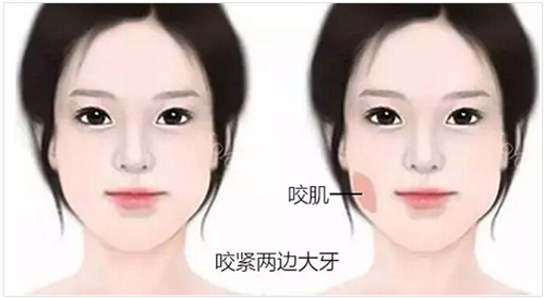 咬肌肥大