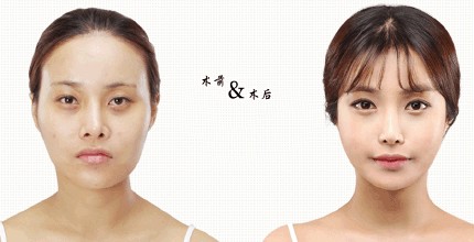 酒窝整形有没有半永.久的 酒窝整形有哪些方法