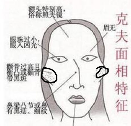 颧骨整形手术后遗症有哪些 颧骨整形手术有风险吗