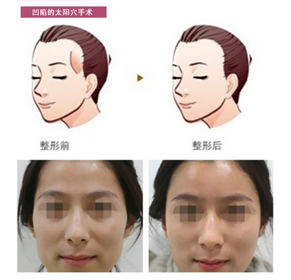 丰太阳穴是自体脂肪好还是玻尿酸填充好?
