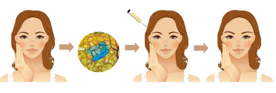 丰太阳穴是自体脂肪好还是玻尿酸填充好?