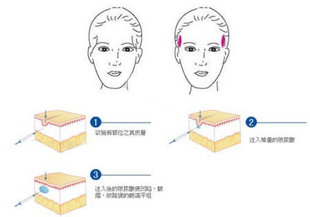 丰太阳穴是自体脂肪好还是玻尿酸填充好?