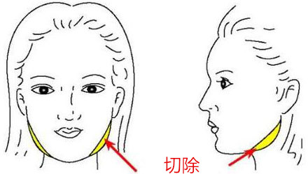 咬肌切除术和注射打B****相比哪一种比较好
