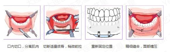 【垫下巴手术】垫下巴手术有什么后遗症 垫下巴手术后所有注意事项