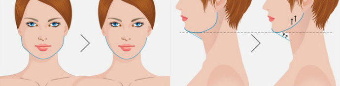 v-line手术整形做出u美人蛇精女李蒽熙
