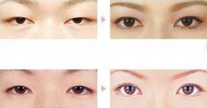 开眼角手术的注意事项有哪些 开眼角前后对比照片