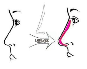 假体隆鼻对人的身体有危害吗