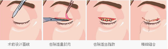 双眼皮手术多少钱 双眼皮手术有后遗症吗