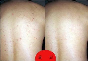 男士后背长痘怎么办 男士后背长痘应注意什么