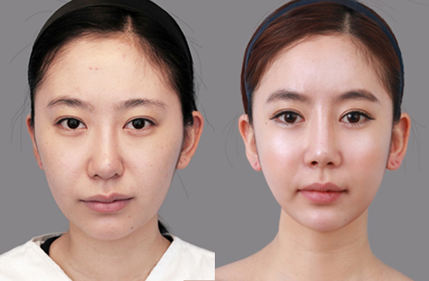 去颊脂垫和面部吸脂哪种瘦脸效果好?