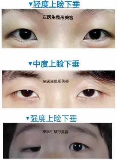上睑下垂分级