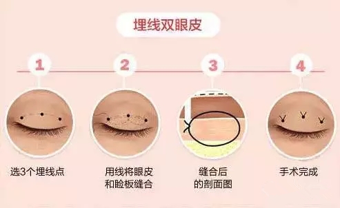 双眼皮手术方法有哪几种 埋线双眼皮拆完线用什么敷眼睛